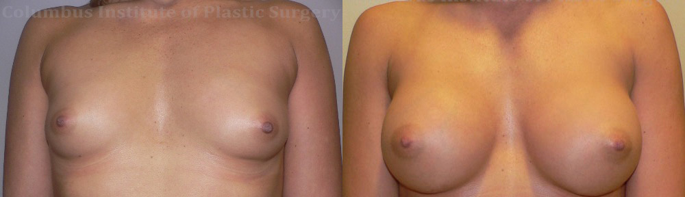 Breast Augmentation – 400cc-500cc before and after photo by Columbus Institute of Plastic Surgery in Columbus, OH