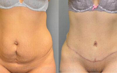 Abdominoplasty (Tummy Tuck) before and after photo by Columbus Institute of Plastic Surgery in Columbus, OH Abdominoplasty (Tummy Tuck) before and after photo by Columbus Institute of Plastic Surgery in Columbus, OH