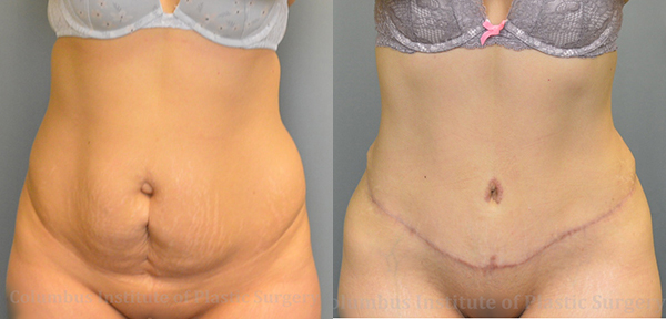Abdominoplasty (Tummy Tuck) before and after photo by Columbus Institute of Plastic Surgery in Columbus, OH