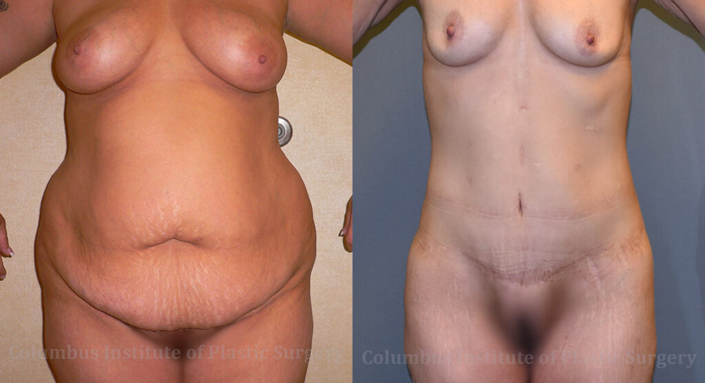 Liposuction before and after photo by Columbus Institute of Plastic Surgery in Columbus, OH