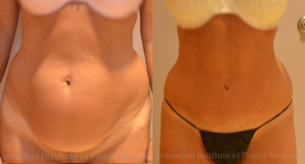 Abdominoplasty (Tummy Tuck) before and after photo by Columbus Institute of Plastic Surgery in Columbus, OH