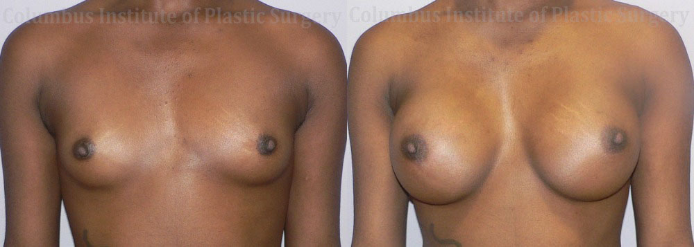 Breast Augmentation – 400cc-500cc before and after photo by Columbus Institute of Plastic Surgery in Columbus, OH
