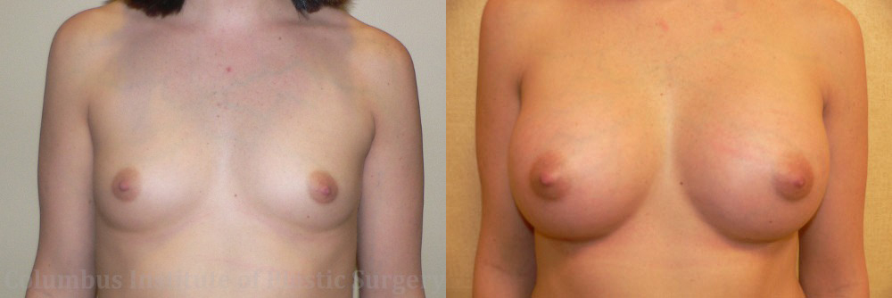 Breast Augmentation – 300cc-400cc before and after photo by Columbus Institute of Plastic Surgery in Columbus, OH