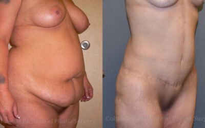 Abdominoplasty (Tummy Tuck) before and after photo by Columbus Institute of Plastic Surgery in Columbus, OH Abdominoplasty (Tummy Tuck) before and after photo by Columbus Institute of Plastic Surgery in Columbus, OH