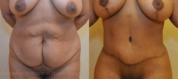 Abdominoplasty (Tummy Tuck) before and after photo by Columbus Institute of Plastic Surgery in Columbus, OH