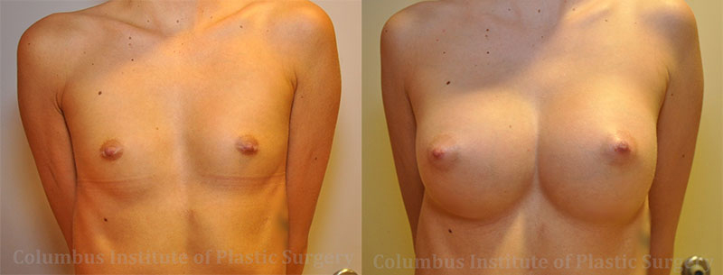 Breast Augmentation before and after photo by Columbus Institute of Plastic Surgery in Columbus, OH