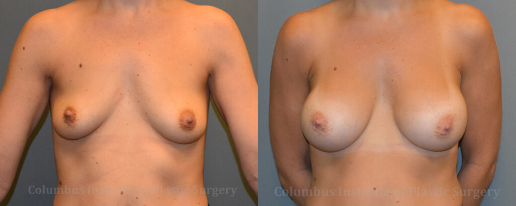 Breast Augmentation – 400cc-500cc before and after photo by Columbus Institute of Plastic Surgery in Columbus, OH