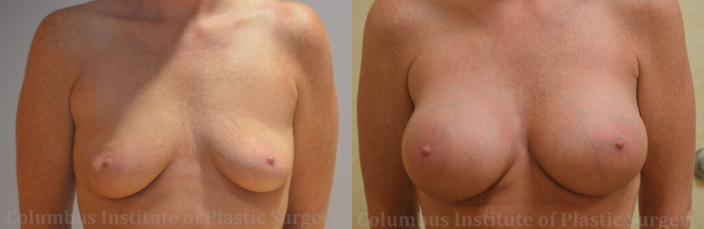 Breast Augmentation – 300cc-400cc before and after photo by Columbus Institute of Plastic Surgery in Columbus, OH