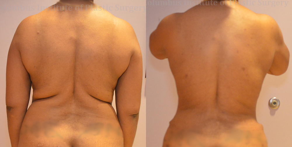 Liposuction before and after photo by Columbus Institute of Plastic Surgery in Columbus, OH