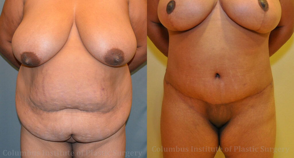 Abdominoplasty (Tummy Tuck) before and after photo by Columbus Institute of Plastic Surgery in Columbus, OH