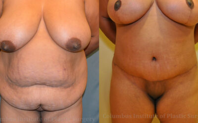 Abdominoplasty (Tummy Tuck) before and after photo by Columbus Institute of Plastic Surgery in Columbus, OH Abdominoplasty (Tummy Tuck) before and after photo by Columbus Institute of Plastic Surgery in Columbus, OH