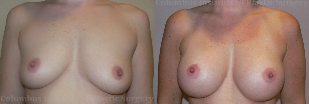 Breast Augmentation – 300cc-400cc before and after photo by Columbus Institute of Plastic Surgery in Columbus, OH