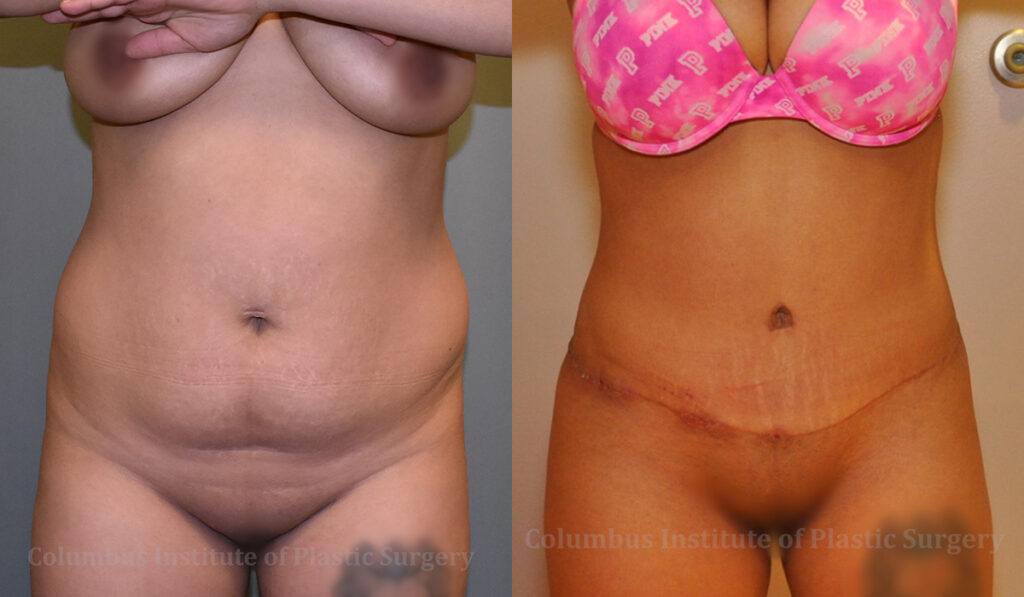 Liposuction before and after photo by Columbus Institute of Plastic Surgery in Columbus, OH