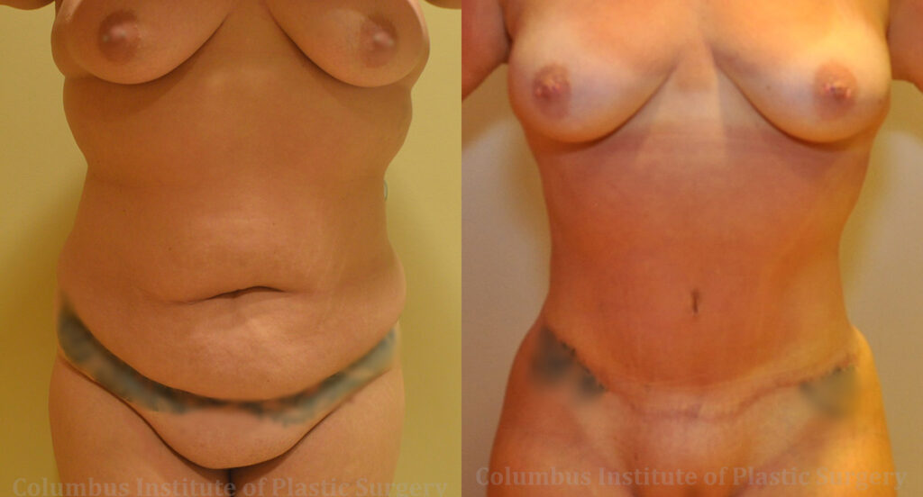 Abdominoplasty (Tummy Tuck) before and after photo by Columbus Institute of Plastic Surgery in Columbus, OH