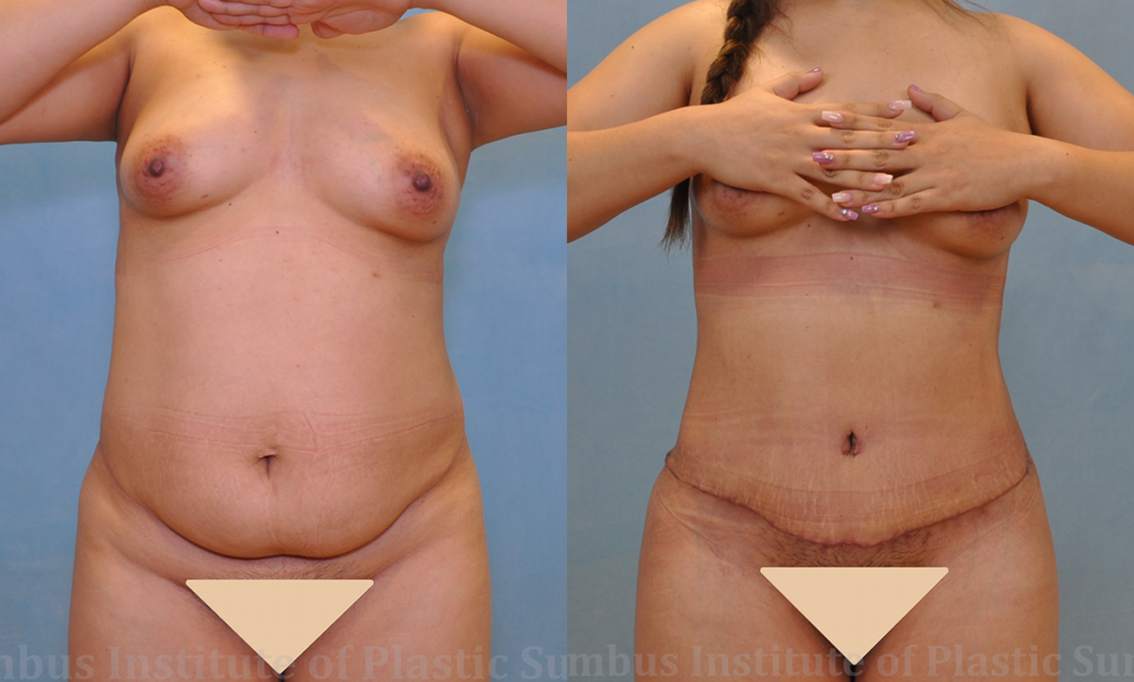 Abdominoplasty (Tummy Tuck) before and after photo by Columbus Institute of Plastic Surgery in Columbus, OH