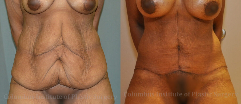 Abdominoplasty after Weight Loss before and after photo by Columbus Institute of Plastic Surgery in Columbus, OH