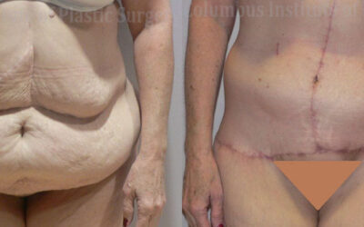 Belt Lipectomy before and after photo by Columbus Institute of Plastic Surgery in Columbus, OH Belt Lipectomy before and after photo by Columbus Institute of Plastic Surgery in Columbus, OH
