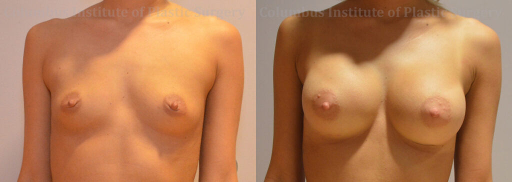 Breast Augmentation – 200cc-300cc before and after photo by Columbus Institute of Plastic Surgery in Columbus, OH