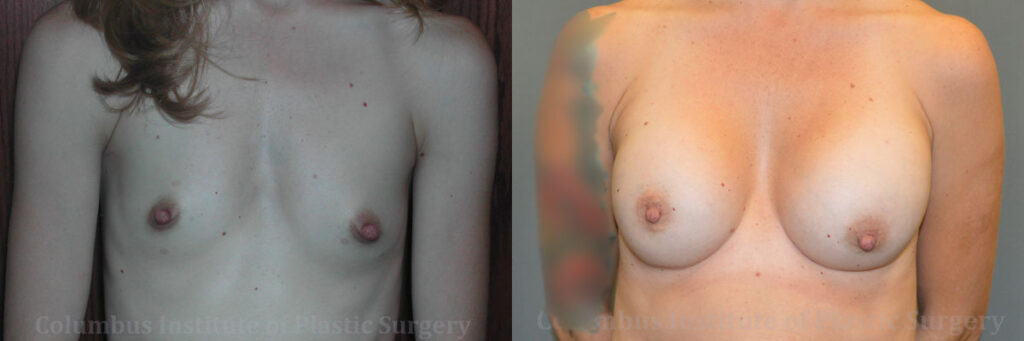 Breast Augmentation – 300cc-400cc before and after photo by Columbus Institute of Plastic Surgery in Columbus, OH