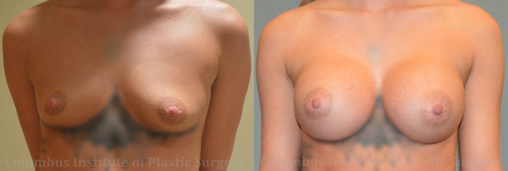Breast Augmentation – 400cc-500cc before and after photo by Columbus Institute of Plastic Surgery in Columbus, OH