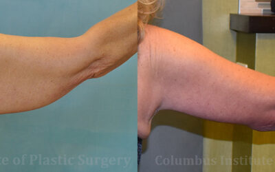 Brachioplasty (Arm Lift) before and after photo by Columbus Institute of Plastic Surgery in Columbus, OH Brachioplasty (Arm Lift) before and after photo by Columbus Institute of Plastic Surgery in Columbus, OH