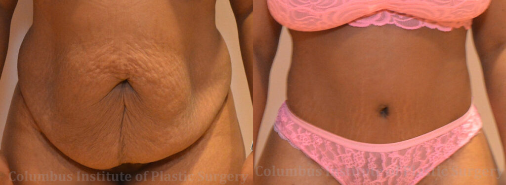 Abdominoplasty (Tummy Tuck) before and after photo by Columbus Institute of Plastic Surgery in Columbus, OH