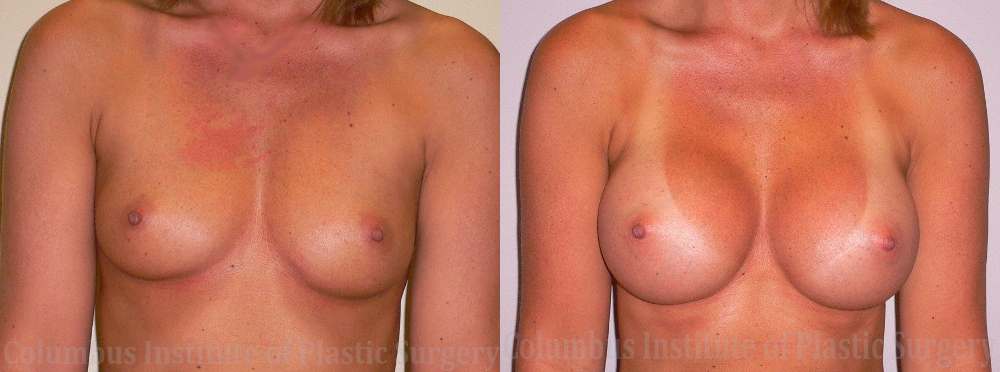 Breast Augmentation – 300cc-400cc before and after photo by Columbus Institute of Plastic Surgery in Columbus, OH