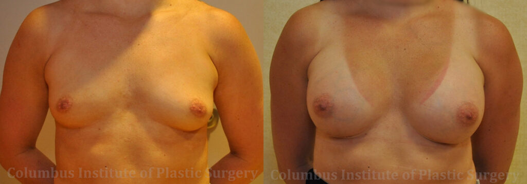 Breast Augmentation – 300cc-400cc before and after photo by Columbus Institute of Plastic Surgery in Columbus, OH
