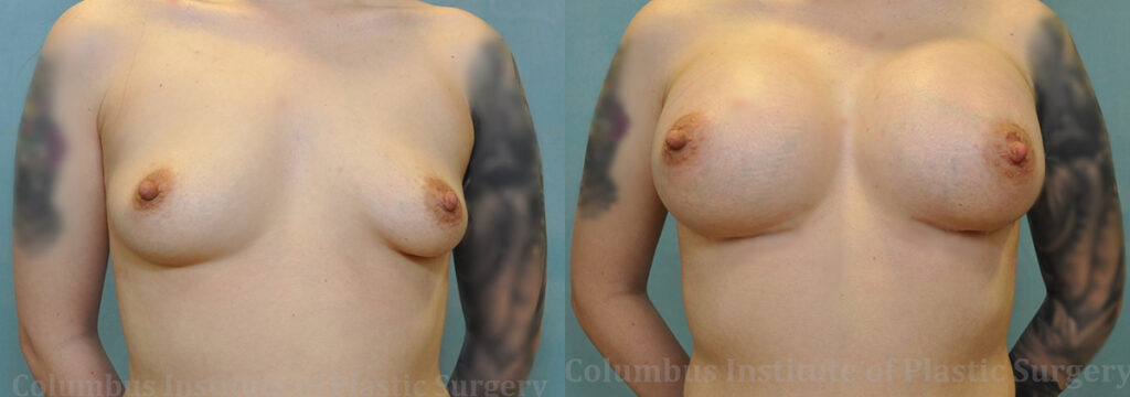 Breast Augmentation – 400cc-500cc before and after photo by Columbus Institute of Plastic Surgery in Columbus, OH