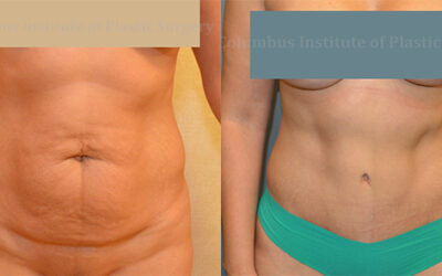 Abdominoplasty (Tummy Tuck) before and after photo by Columbus Institute of Plastic Surgery in Columbus, OH Abdominoplasty (Tummy Tuck) before and after photo by Columbus Institute of Plastic Surgery in Columbus, OH