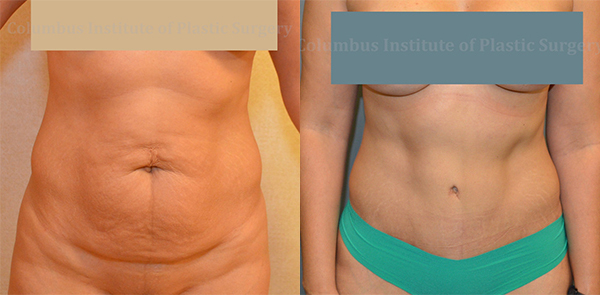 Abdominoplasty (Tummy Tuck) before and after photo by Columbus Institute of Plastic Surgery in Columbus, OH