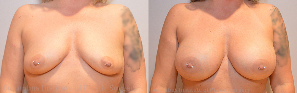 Breast Augmentation – 600cc-700cc before and after photo by Columbus Institute of Plastic Surgery in Columbus, OH