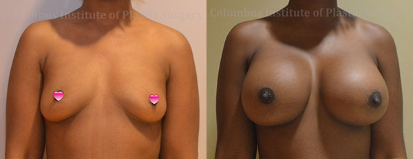 Breast Augmentation – 600cc-700cc before and after photo by Columbus Institute of Plastic Surgery in Columbus, OH