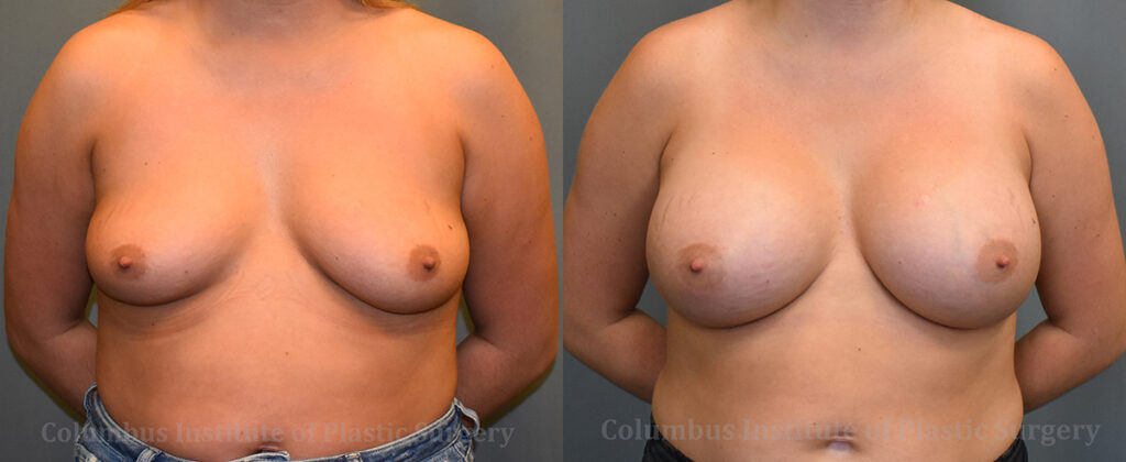 Breast Augmentation – 600cc-700cc before and after photo by Columbus Institute of Plastic Surgery in Columbus, OH