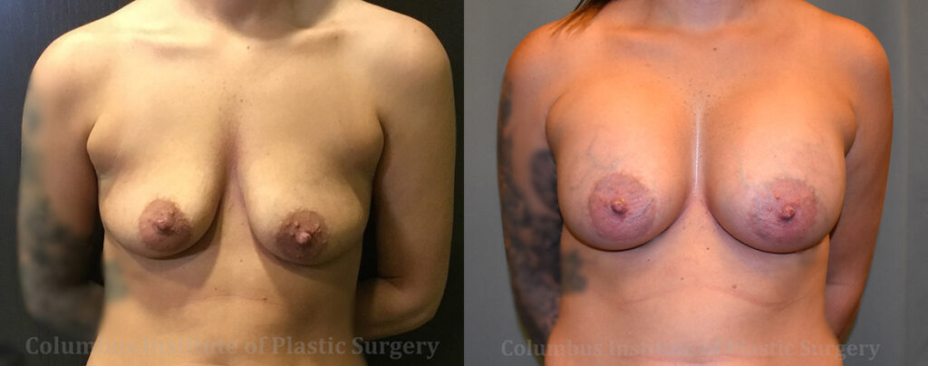 Breast Augmentation – 600cc-700cc before and after photo by Columbus Institute of Plastic Surgery in Columbus, OH