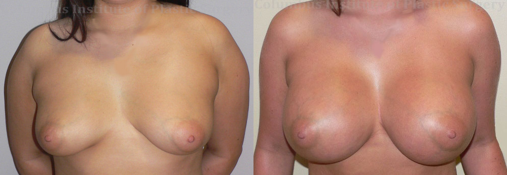 Breast Augmentation – 600cc-700cc before and after photo by Columbus Institute of Plastic Surgery in Columbus, OH