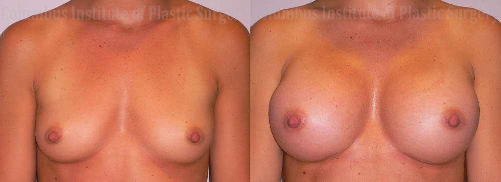 Breast Augmentation – 600cc-700cc before and after photo by Columbus Institute of Plastic Surgery in Columbus, OH