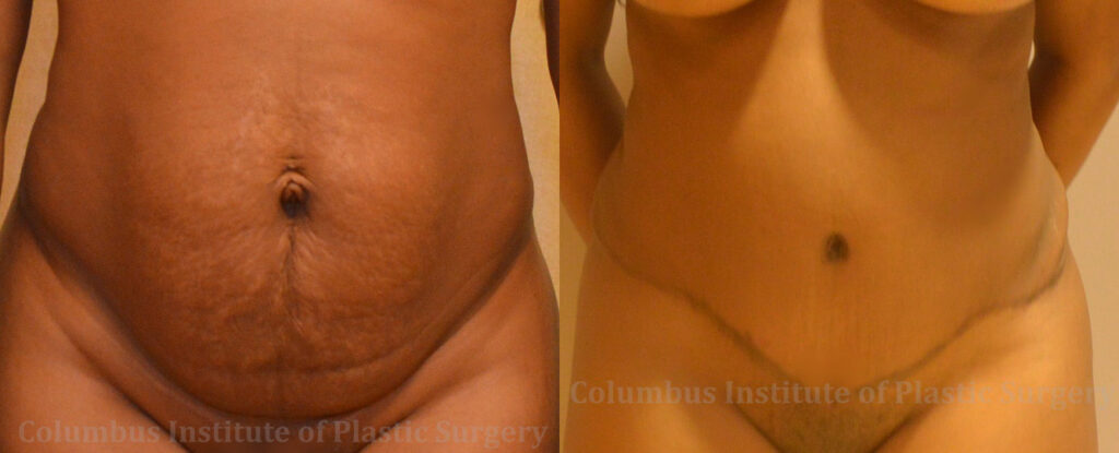 Abdominoplasty (Tummy Tuck) before and after photo by Columbus Institute of Plastic Surgery in Columbus, OH
