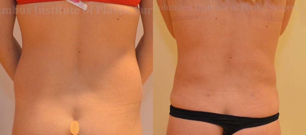 Liposuction before and after photo by Columbus Institute of Plastic Surgery in Columbus, OH