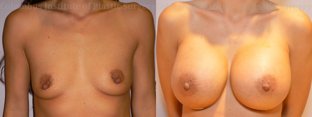 Breast Augmentation – 700cc-800cc before and after photo by Columbus Institute of Plastic Surgery in Columbus, OH