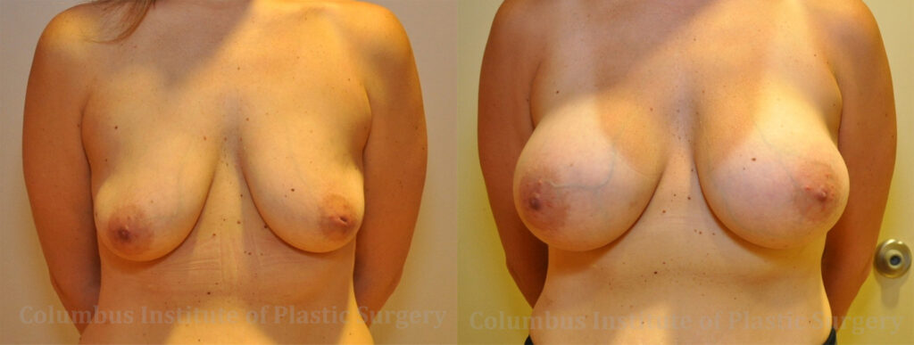 Breast Augmentation before and after photo by Columbus Institute of Plastic Surgery in Columbus, OH
