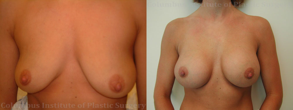 Breast Augmentation before and after photo by Columbus Institute of Plastic Surgery in Columbus, OH