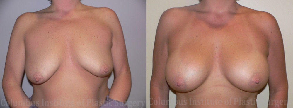 Breast Augmentation before and after photo by Columbus Institute of Plastic Surgery in Columbus, OH
