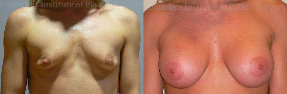 Breast Augmentation before and after photo by Columbus Institute of Plastic Surgery in Columbus, OH