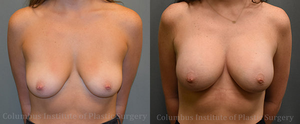 Breast Augmentation before and after photo by Columbus Institute of Plastic Surgery in Columbus, OH
