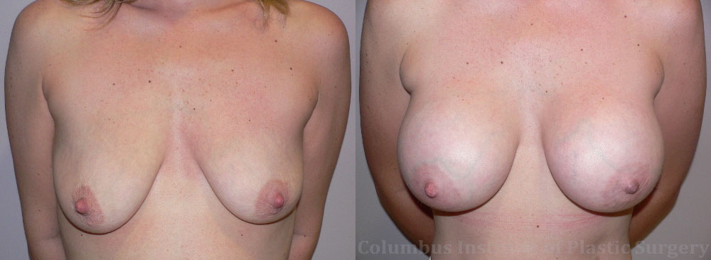 Breast Augmentation before and after photo by Columbus Institute of Plastic Surgery in Columbus, OH