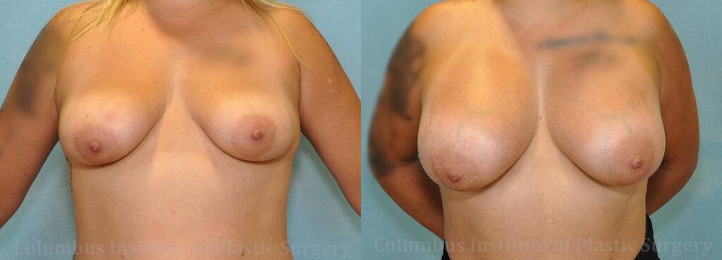 Breast Augmentation before and after photo by Columbus Institute of Plastic Surgery in Columbus, OH