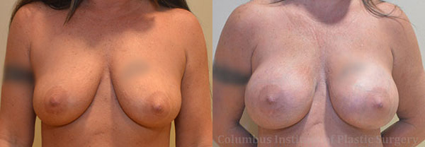 Breast Augmentation before and after photo by Columbus Institute of Plastic Surgery in Columbus, OH