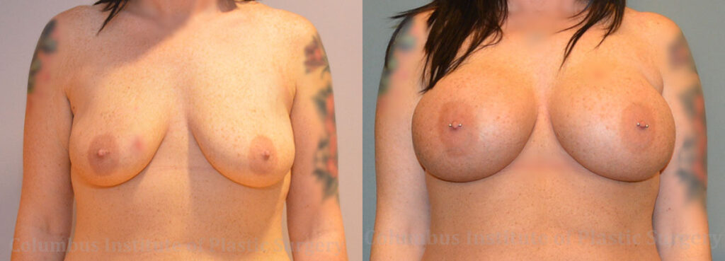 Breast Augmentation before and after photo by Columbus Institute of Plastic Surgery in Columbus, OH
