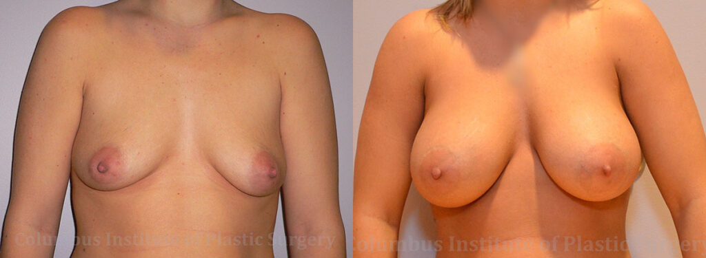 Breast Augmentation before and after photo by Columbus Institute of Plastic Surgery in Columbus, OH